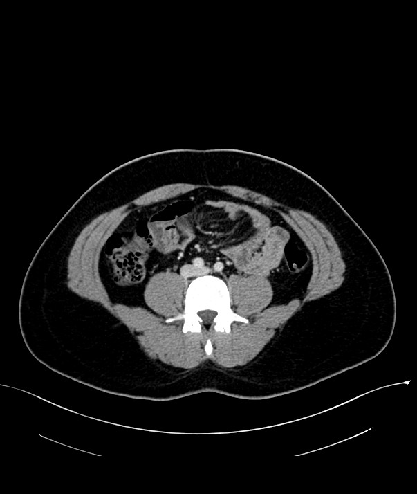 Chromophobe renal cell carcinoma (Radiopaedia 84255-99542 F 49).jpg