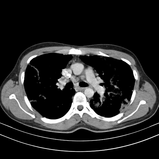 Chronic eosinophilic pneumonia (Radiopaedia 39331-41587 Axial C+ delayed 48).png