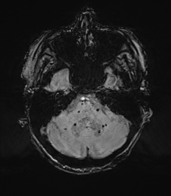Chronic hypertensive encephalopathy (Radiopaedia 72844-83495 Axial SWI 19).png
