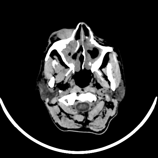 File:Chronic invasive fungal sinusitis with intraorbital and intracranial extension (Radiopaedia 56387-63046 Axial non-contrast 58).jpg