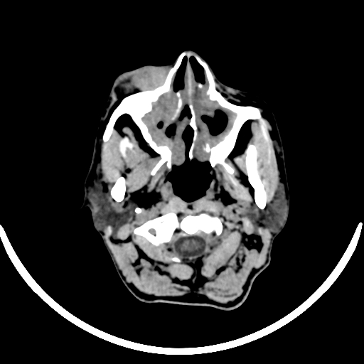 File:Chronic invasive fungal sinusitis with intraorbital and intracranial extension (Radiopaedia 56387-63046 Axial non-contrast 59).jpg