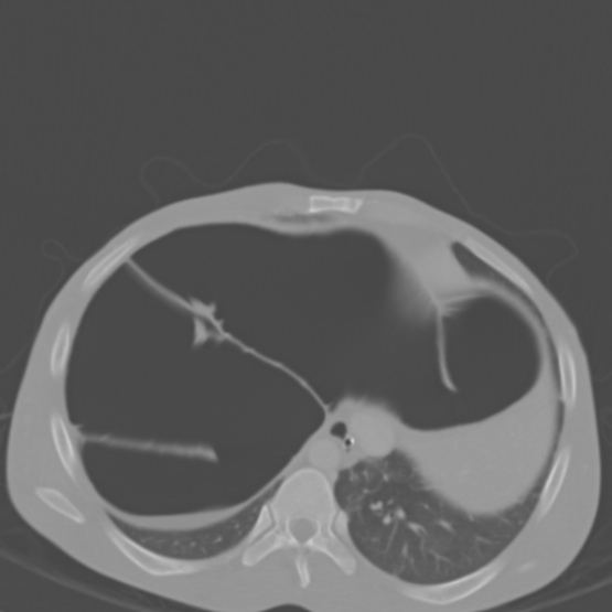 Chronic large bowel pseudo-obstruction (Radiopaedia 43181-46492 Axial bone window 33).jpg
