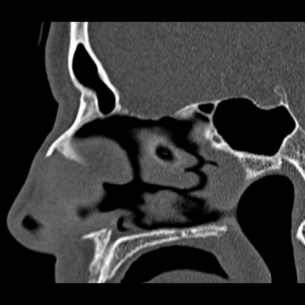 Chronic maxillary sinusitis (Radiopaedia 27879-28116 Sagittal bone window 26).jpg