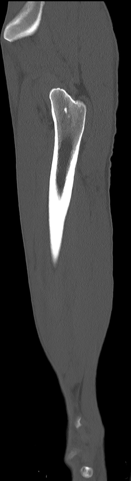 Chronic osteomyelitis (with sequestrum) (Radiopaedia 74813-85822 C 21).jpg