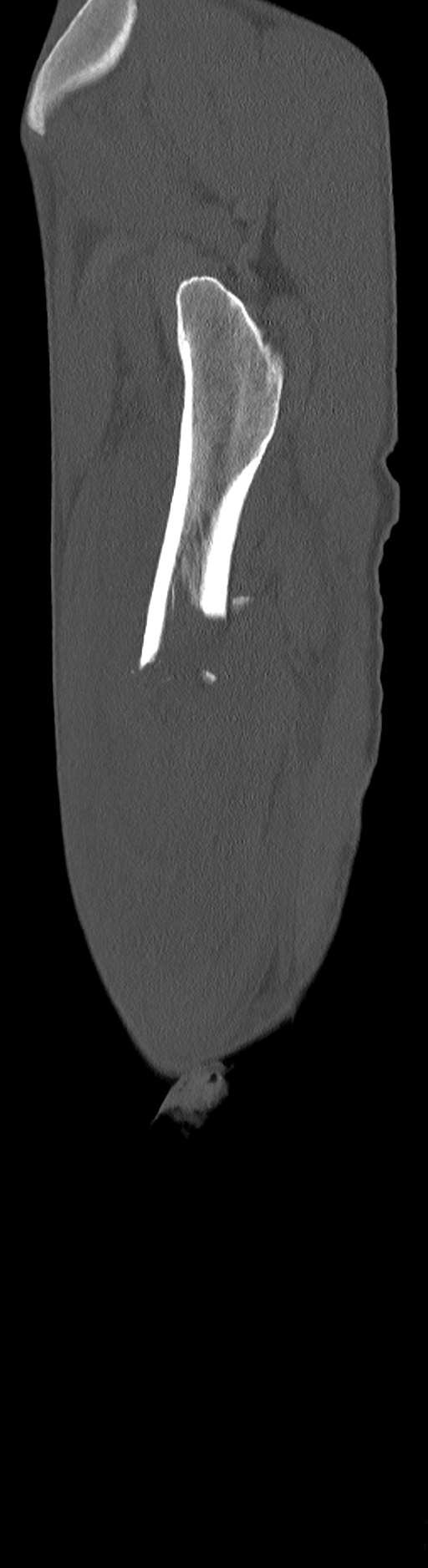 Chronic osteomyelitis (with sequestrum) (Radiopaedia 74813-85822 C 95).jpg