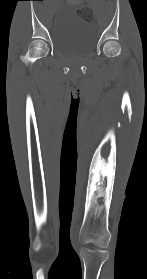 Chronic osteomyelitis (with sequestrum) (Radiopaedia 74813-85822 Coronal non-contrast 23).jpg