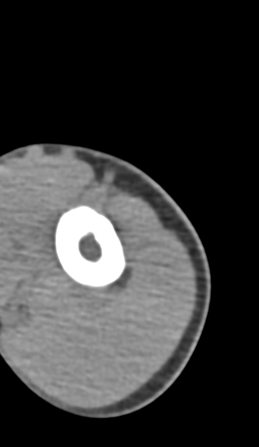 Chronic osteomyelitis of the distal humerus (Radiopaedia 78351-90971 Axial non-contrast 27).jpg