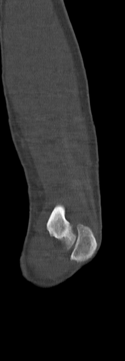 Chronic osteomyelitis of the distal humerus (Radiopaedia 78351-90971 Sagittal bone window 61).jpg