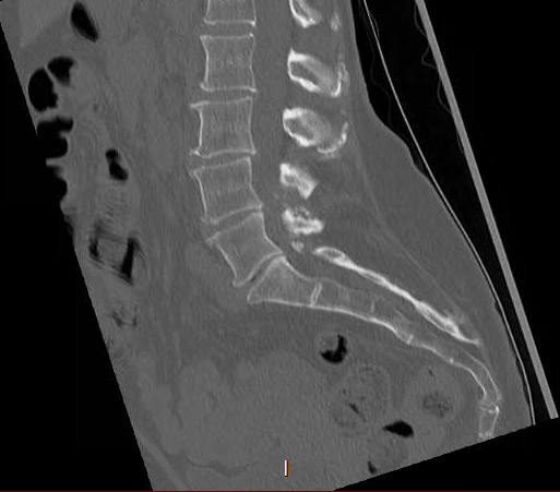 File:Chronic spinal hematoma with cauda equina syndrome (Radiopaedia 75745-88197 Sagittal bone window 16).png