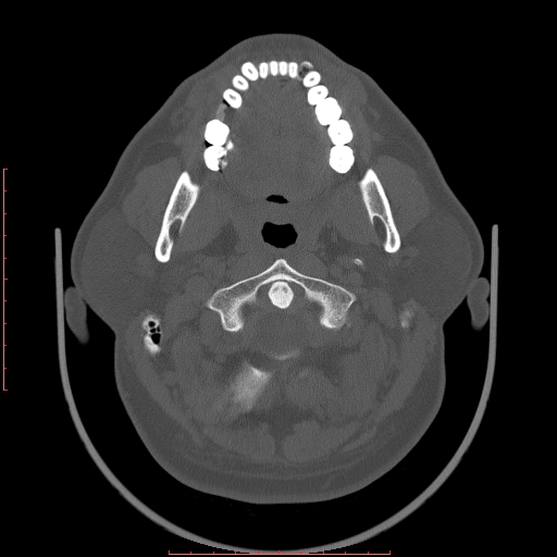 Chronic submandibular sialolithiasis (Radiopaedia 69817-79814 Axial bone window 27).jpg