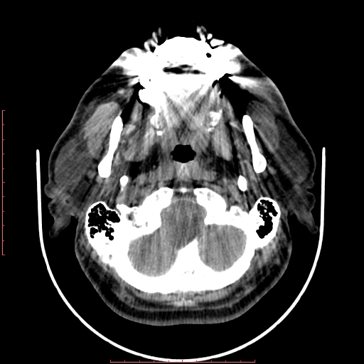 Chronic submandibular sialolithiasis (Radiopaedia 69817-79814 Axial non-contrast 44).jpg