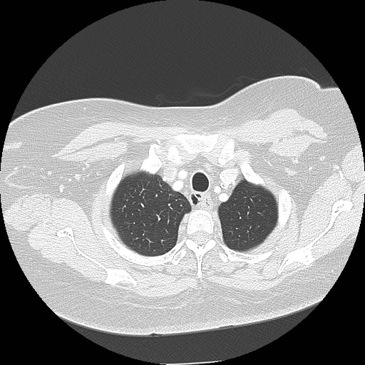 Cicatrisation collapse (Radiopaedia 17405-17089 lung window 16).jpg