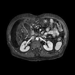 File:Cirrhosis and hepatocellular carcinoma in the setting of hemochromatosis (Radiopaedia 75394-86594 Axial T1 C+ fat sat 197).jpg