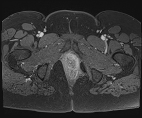 File:Class II Mullerian duct anomaly- unicornuate uterus with rudimentary horn and non-communicating cavity (Radiopaedia 39441-41755 Axial T1 fat sat 135).jpg