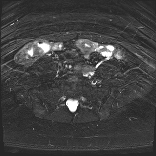File:Class II Mullerian duct anomaly- unicornuate uterus with rudimentary horn and non-communicating cavity (Radiopaedia 39441-41755 Axial T2 fat sat 4).jpg