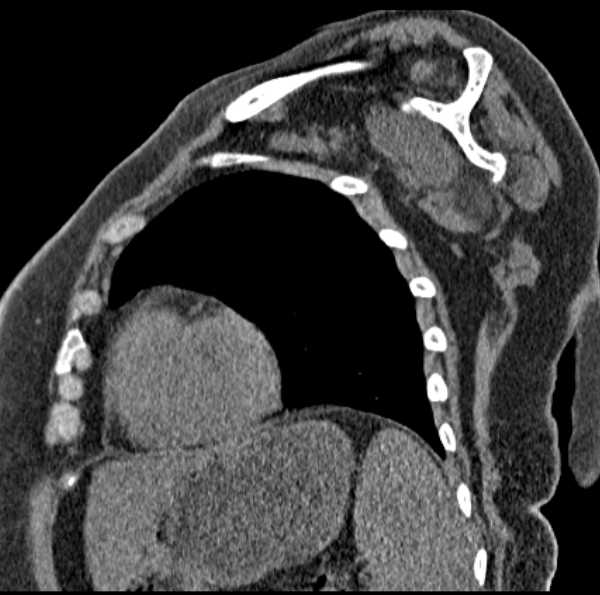 Clear cell chondrosarcoma - humerus (Radiopaedia 63104-71612 D 43).jpg