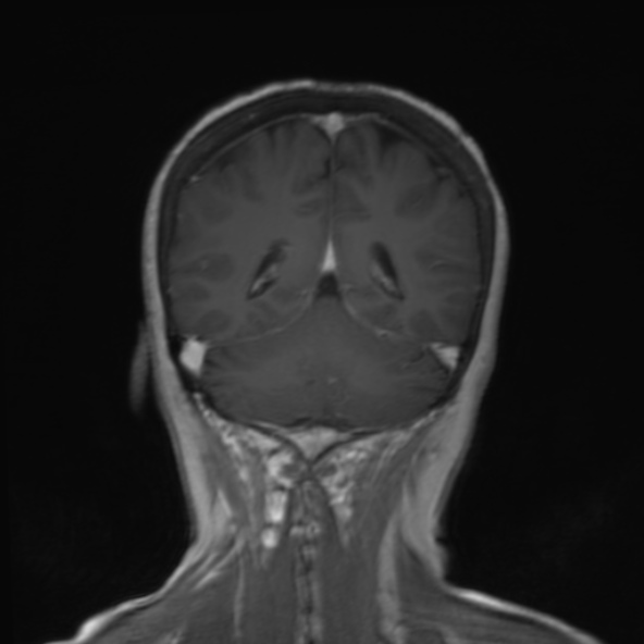 File:Clival meningioma (Radiopaedia 53278-59248 F 21).jpg