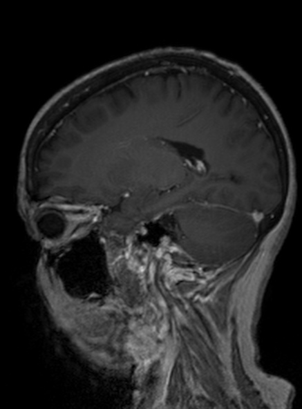 Clival meningioma (Radiopaedia 53278-59248 Sagittal T1 C+ 299).jpg