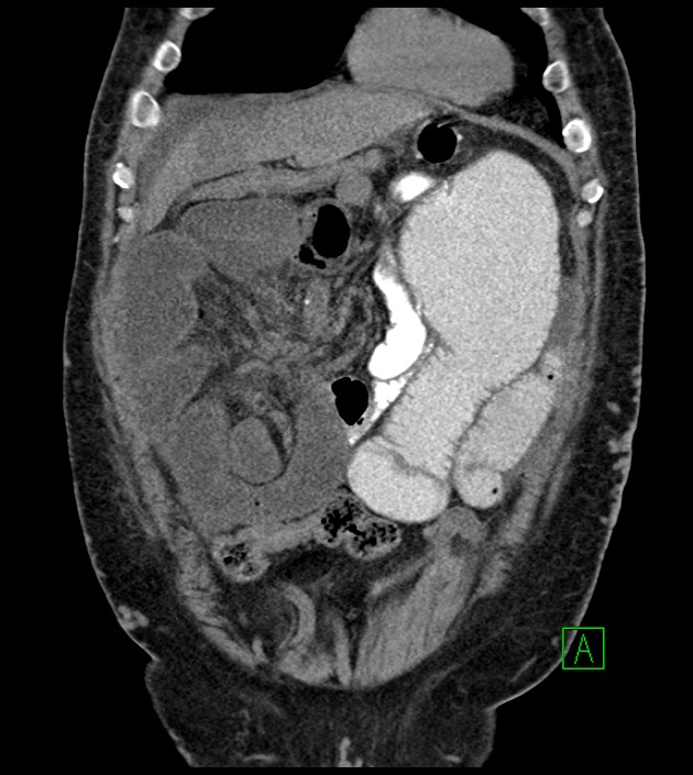 Closed-loop small bowel obstruction-internal hernia (Radiopaedia 78439-91096 Coronal non-contrast 31).jpg