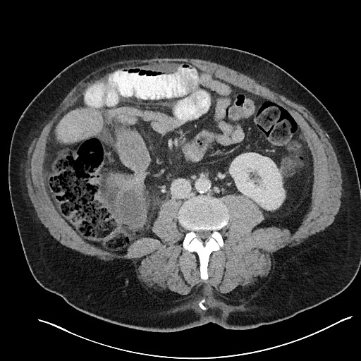 File:Closed loop obstruction - internal hernia into nephrectomy bed (Radiopaedia 59867-67320 A 78).jpg