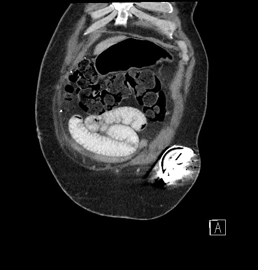 Closed loop obstruction - internal hernia into nephrectomy bed (Radiopaedia 59867-67320 B 8).jpg