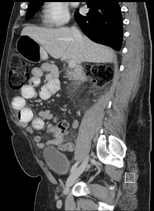 Closed loop obstruction - internal hernia into nephrectomy bed (Radiopaedia 59867-67320 C 60).jpg