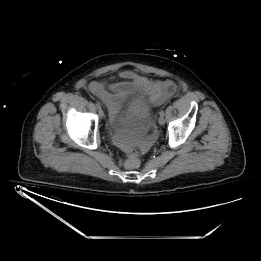 File:Closed loop obstruction due to adhesive band, resulting in small bowel ischemia and resection (Radiopaedia 83835-99023 Axial non-contrast 134).jpg