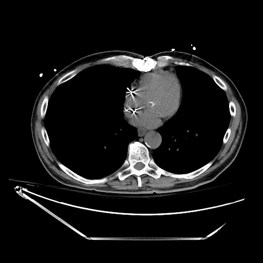 File:Closed loop obstruction due to adhesive band, resulting in small bowel ischemia and resection (Radiopaedia 83835-99023 Axial non-contrast 9).jpg