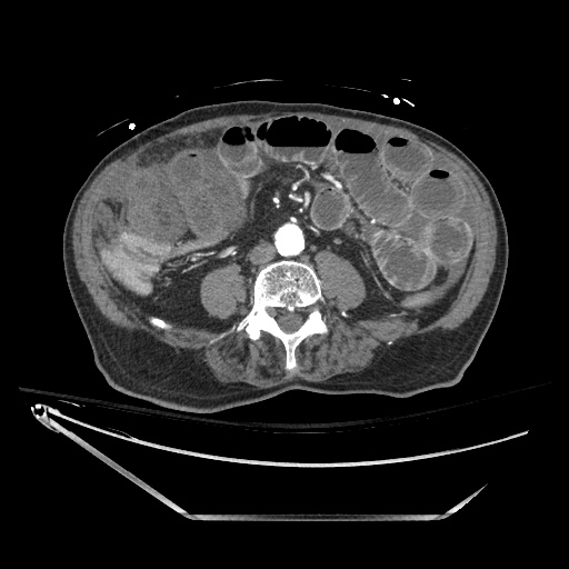 File:Closed loop obstruction due to adhesive band, resulting in small bowel ischemia and resection (Radiopaedia 83835-99023 B 89).jpg