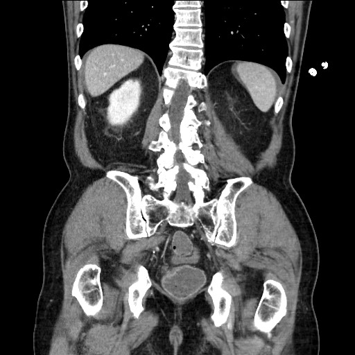 Closed loop obstruction due to adhesive band, resulting in small bowel ischemia and resection (Radiopaedia 83835-99023 E 97).jpg