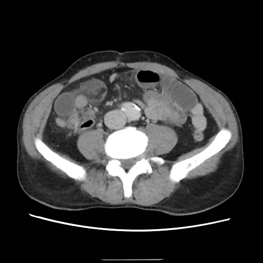 File:Closed loop small bowel obstruction (Radiopaedia 59227-66554 A 54).jpg