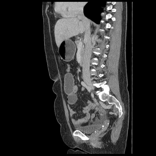 Closed loop small bowel obstruction (Radiopaedia 65403-74451 C 45).jpg