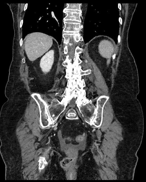 Closed loop small bowel obstruction - adhesions (Radiopaedia 59269-66611 B 94).jpg