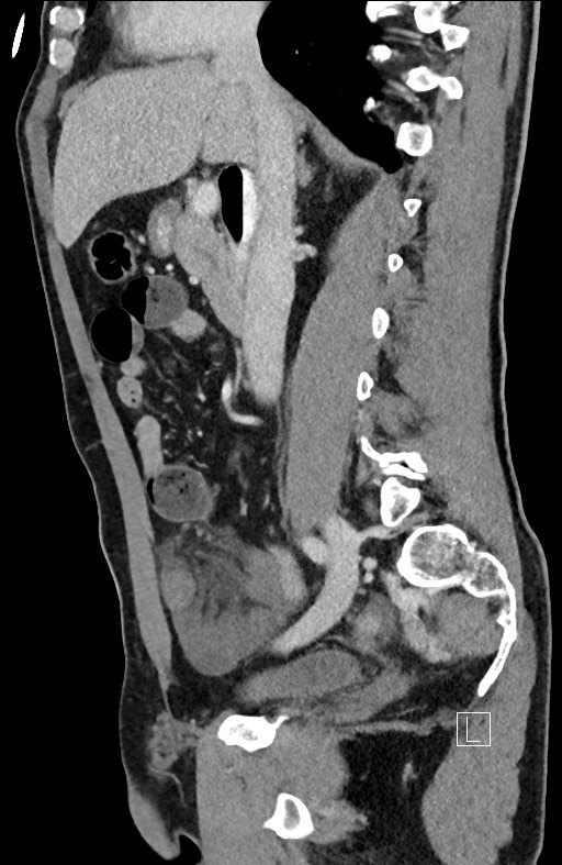 Closed loop small bowel obstruction - internal hernia (Radiopaedia 57806-64778 C 66).jpg
