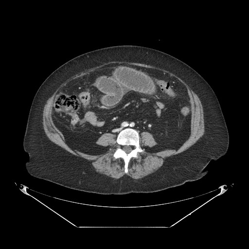 Closed loop small bowel obstruction - internal hernia (Radiopaedia 65402-74450 A 76).jpg