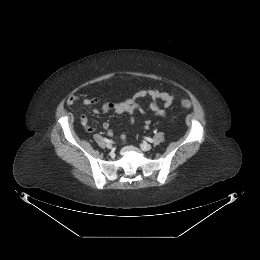 Closed loop small bowel obstruction - internal hernia (Radiopaedia 65402-74450 A 95).jpg