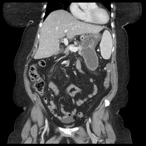 Closed loop small bowel obstruction - internal hernia (Radiopaedia 65402-74450 B 45).jpg
