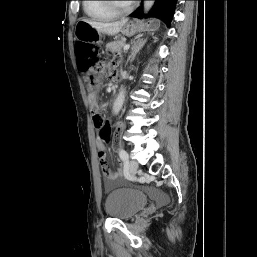 Closed loop small bowel obstruction - omental adhesion causing "internal hernia" (Radiopaedia 85129-100682 C 108).jpg