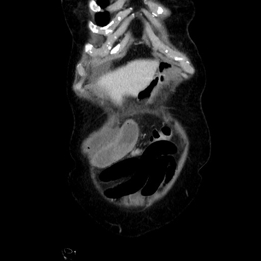 Closed loop small bowel obstruction due to adhesive band, with intramural hemorrhage and ischemia (Radiopaedia 83831-99017 C 22).jpg