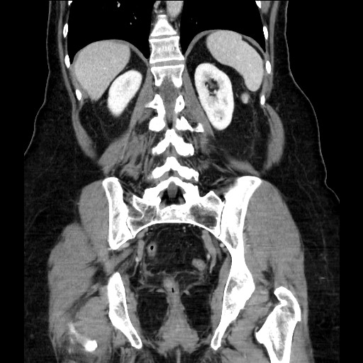 File:Closed loop small bowel obstruction due to adhesive bands - early and late images (Radiopaedia 83830-99014 B 90).jpg