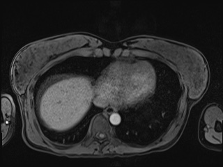 Closed loop small bowel obstruction in pregnancy (MRI) (Radiopaedia 87637-104031 Axial T1 fat sat 10).jpg
