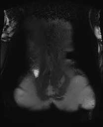 File:Closed loop small bowel obstruction in pregnancy (MRI) (Radiopaedia 87637-104031 Coronal T2 fat sat 49).jpg