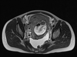 Closed loop small bowel obstruction in pregnancy (MRI) (Radiopaedia 87637-104031 D 29).jpg