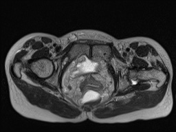 Closed loop small bowel obstruction in pregnancy (MRI) (Radiopaedia 87637-104031 D 39).jpg
