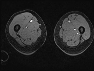 Closed loop small bowel obstruction in pregnancy (MRI) (Radiopaedia 87637-104031 G 64).jpg