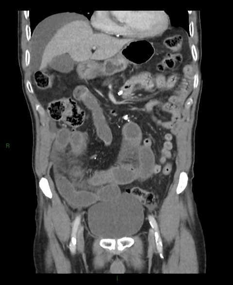 Closed loop small bowel obstruction with ischemia (Radiopaedia 84180-99456 B 44).jpg