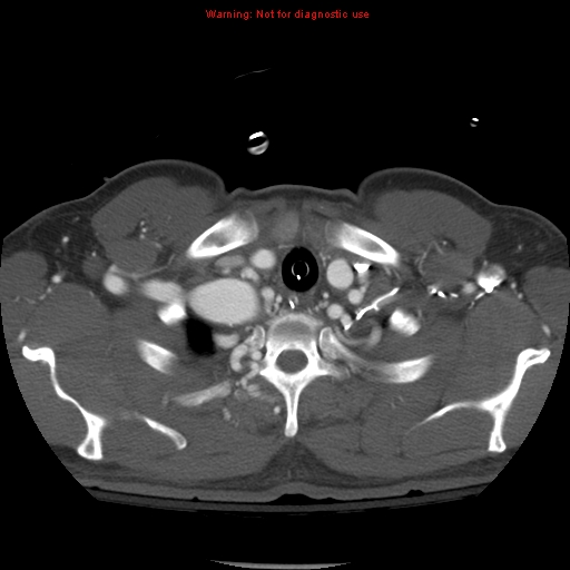 File:Coarctation of the aorta (Radiopaedia 8681-9490 B 11).jpg
