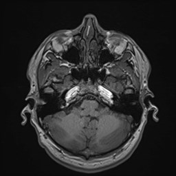 Cochlear incomplete partition type III associated with hypothalamic hamartoma (Radiopaedia 88756-105498 Axial T1 56).jpg