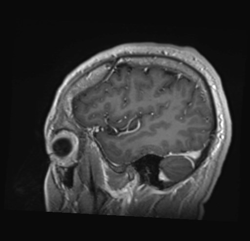 Cochlear incomplete partition type III associated with hypothalamic hamartoma (Radiopaedia 88756-105498 Sagittal T1 C+ 12).jpg