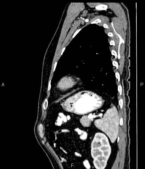 Colon adenocarcinoma (Radiopaedia 83266-97671 D 86).jpg